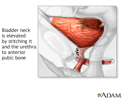 Multimedia Encyclopedia Stress Urinary Incontinence
