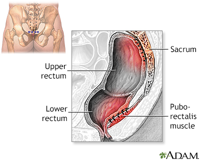 Multimedia Encyclopedia Rectal Prolapse
